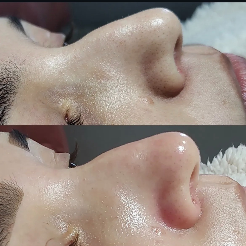 Limpeza de Pele